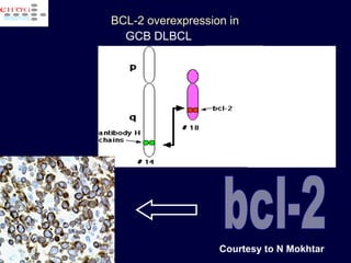 bcl-2 BCL-2 overexpression in  GCB DLBCL   Courtesy to N Mokhtar  