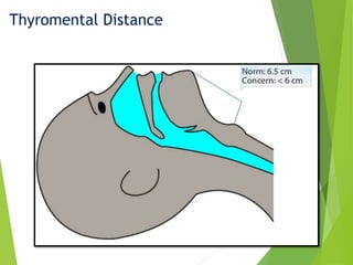 Thyromental Distance
 