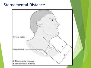 Sternomental Distance
 