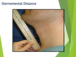 -Sternomental Distance
 