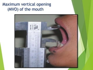 Maximum vertical opening
(MVO) of the mouth
 