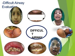 -Difficult Airway
Evaluation
DIFFICUL
T
AIRWAY
 