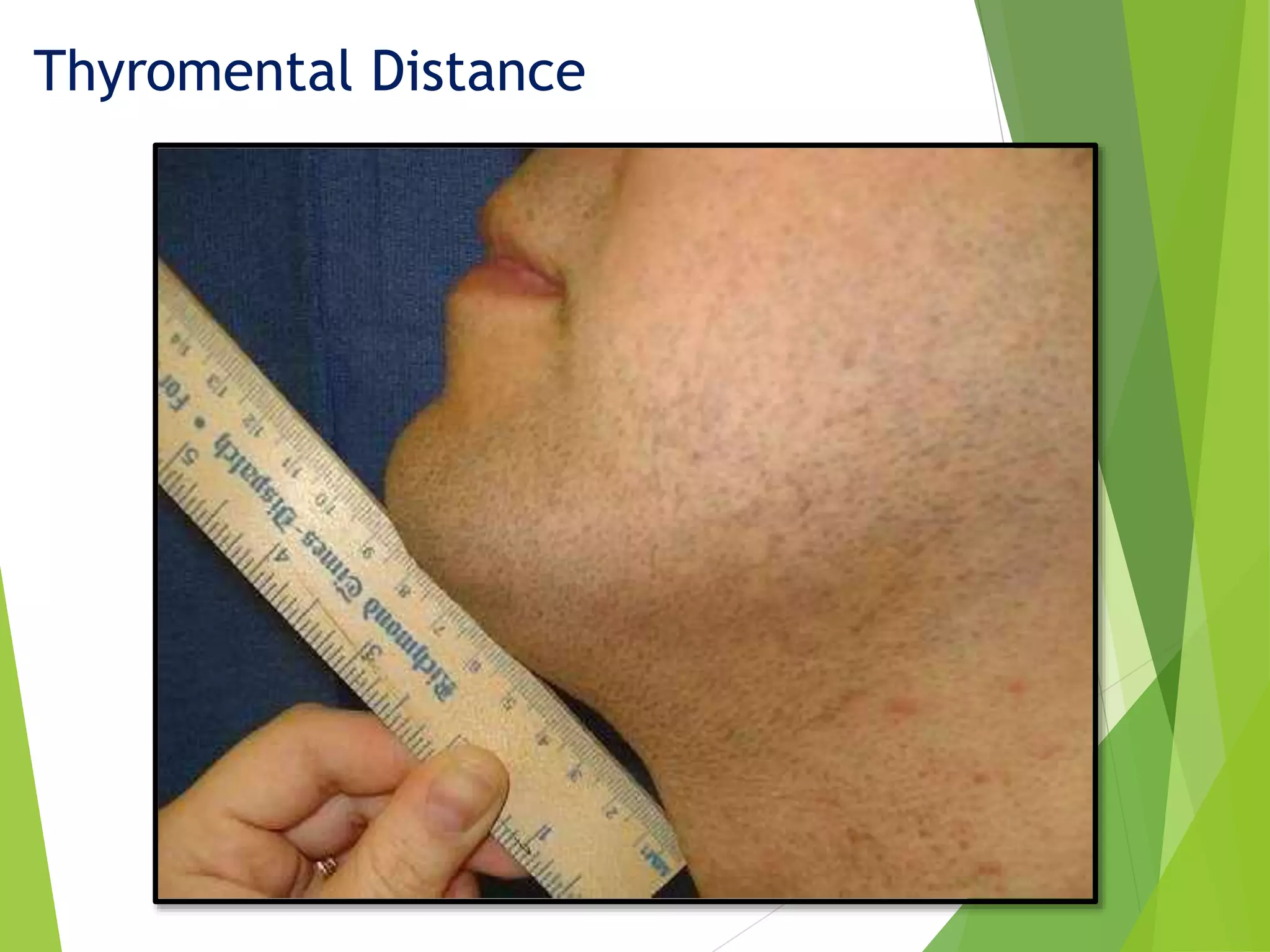 general anesthesia-Anesthesia | PDF