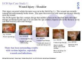 ECB Spa Case Study 1: 
Wound Injury ­ Shoulder 
This injury occurred whilst the mare was out in the field (Fig 1.).  The wound was initially 
sutured but unfortunately broke down.  The mare then received cold water spa therapy directly 
onto the wound. 
The ECB equine Spa has a unique design that enables a hose to be attached and cold water 
therapy performed in the spa to re­circulate the spa solution. Injuries above the thoracic cavity 
can then receive cold water therapy. 
There has been astounding results There has been astounding results 
with various injuries, especially with various injuries, especially 
wounds and infections. wounds and infections. 
Fig 1: 15/12/03 
Prior to spa therapy.  Fig 2: 22/12/03 
1 week of spa therapy. 
Healthy wound with 
visible healing 
Fig 3: 06/01/04 
3 weeks of spa therapy. 
Considerable closure of 
wound and hair growth 
Fig 4: 20/01/04 
5 weeks of spa therapy. 
Almost complete 
closure and reduced 
swelling. 
Horse was doing 1 hr 
exercise daily. 
ECB Spa Web Case Study 1: Wound Injury – Shoulder (Ruby, Dec 03 – Jan 04 The Centre for Natural Equine Rehabilitation) 
Fig 5: 28/03/04 
Departure from 
The Centre
 