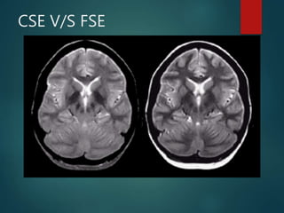 CSE V/S FSE
 Fat remains bright on T2W image in FSE.
 Muscle appear darker on FSE than CSE
 Multiple 180 degree pulses reduce the magnetic
susceptibility effect in FSE
 Artefact from metal implant is significantly reduced
using fast SE.
 The TR of fast SE is much longer than CSE.
 