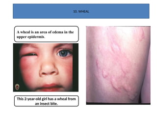 Wheals Examples Introduction to basic skin lesion_PharmD.pptx
