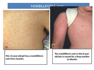 Mobillifom Rash Introduction to basic skin lesion_PharmD.pptx