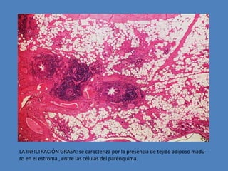 LA INFILTRACIÓN GRASA: se caracteriza por la presencia de tejido adiposo madu-ro 
en el estroma , entre las células del parénquima. 
 