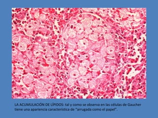 LA ACUMULACIÓN DE LÍPIDOS: tal y como se observa en las células de Gaucher 
tiene una apariencia característica de “arrugada como el papel”. 
 