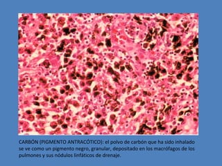 CARBÓN (PIGMENTO ANTRACÓTICO): el polvo de carbón que ha sido inhalado 
se ve como un pigmento negro, granular, depositado en los macrófagos de los 
pulmones y sus nódulos linfáticos de drenaje. 
 