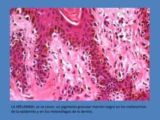 LA MELANINA: se ve como un pigmento granular marrón-negro en los melanocitos 
de la epidermis y en los melanófagos de la dermis. 
 