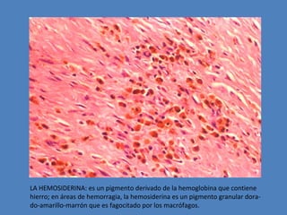 LA HEMOSIDERINA: es un pigmento derivado de la hemoglobina que contiene 
hierro; en áreas de hemorragia, la hemosiderina es un pigmento granular dora-do- 
amarillo-marrón que es fagocitado por los macrófagos. 
 