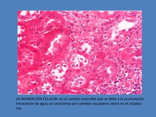 LA INUNDACIÓN CELULAR: es un cambio reversible que se debe a la acumulación 
intracelular de agua; se caracteriza por cambios vacuolares claros en el citoplas-ma. 
 
