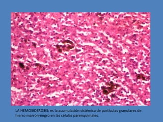 LA HEMOSIDEROSIS: es la acumulación sistémica de partículas granulares de 
hierro marrón-negro en las células parenquimales. 
 