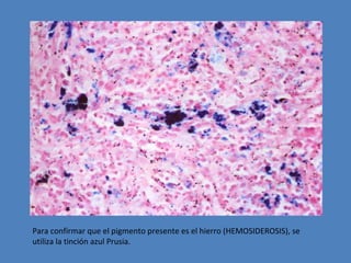Para confirmar que el pigmento presente es el hierro (HEMOSIDEROSIS), se 
utiliza la tinción azul Prusia. 
 