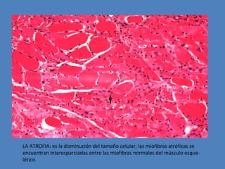 LA ATROFIA: es la disminución del tamaño celular; las miofibras atróficas se 
encuentran interesparciadas entre las miofibras normales del músculo esque-lético. 
 