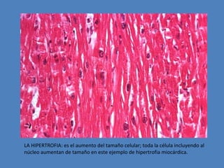 LA HIPERTROFIA: es el aumento del tamaño celular; toda la célula incluyendo al 
núcleo aumentan de tamaño en este ejemplo de hipertrofia miocárdica. 
 