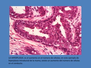 LA HIPERPLASIA: es el aumento en el número de células; en este ejemplo de 
hiperplasia intraductal de la mama, existe un aumento del número de células 
en el conducto. 
 