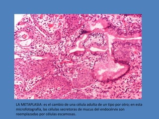 LA METAPLASIA: es el cambio de una célula adulta de un tipo por otro; en esta 
microfotografía, las células secretoras de mucus del endocérvix son 
reemplazadas por células escamosas. 
 