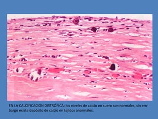 EN LA CALCIFICACIÓN DISTRÓFICA: los niveles de calcio en suero son normales, sin em-bargo 
existe depósito de calcio en tejidos anormales. 
 