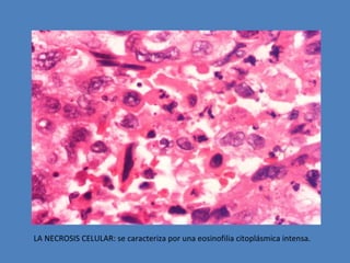 LA NECROSIS CELULAR: se caracteriza por una eosinofilia citoplásmica intensa. 
 
