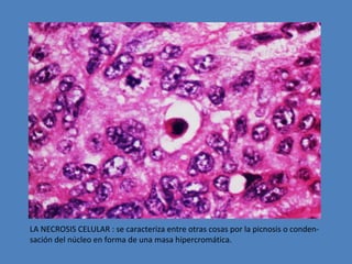 LA NECROSIS CELULAR : se caracteriza entre otras cosas por la picnosis o conden-sación 
del núcleo en forma de una masa hipercromática. 
 