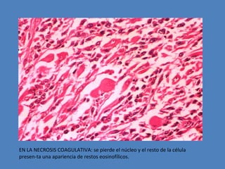 EN LA NECROSIS COAGULATIVA: se pierde el núcleo y el resto de la célula 
presen-ta una apariencia de restos eosinofílicos. 
 