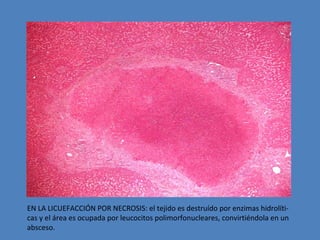 EN LA LICUEFACCIÓN POR NECROSIS: el tejido es destruído por enzimas hidrolíti-cas 
y el área es ocupada por leucocitos polimorfonucleares, convirtiéndola en un 
absceso. 
 