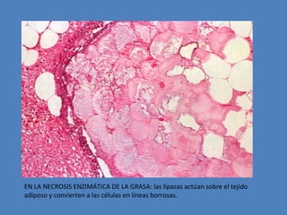EN LA NECROSIS ENZIMÁTICA DE LA GRASA: las lipasas actúan sobre el tejido 
adiposo y convierten a las células en líneas borrosas. 
 