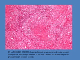 EN LA NECROSIS CASEOSA: la zona afectada se ve como un área de necrosis 
blanquecina. Microscópicamente, la necrosis caseosa se caracteriza por un 
granuloma con necrosis central. 
 