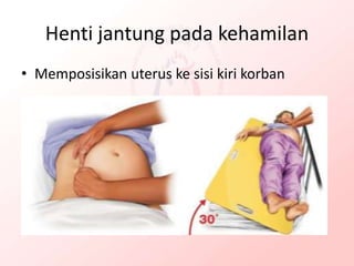 Henti jantung pada kehamilan
• Memposisikan uterus ke sisi kiri korban
 
