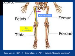 Eje mecánico
Eje
anatómico
6º
Genu varu : > 180º / Genu valgo : < 170º  Artrosis (desgaste prematuro)
 