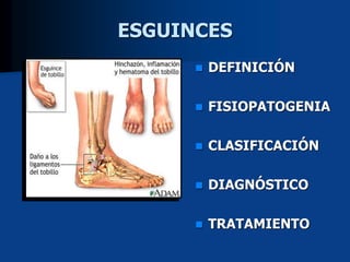 ESGUINCES
 DEFINICIÓN
 FISIOPATOGENIA
 CLASIFICACIÓN
 DIAGNÓSTICO
 TRATAMIENTO
 
