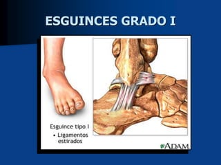 ESGUINCES GRADO I
 