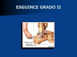 ESGUINCE GRADO II
 