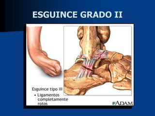 ESGUINCE GRADO II
 