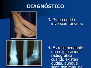 DIAGNÓSTICO
3. Prueba de la
inversión forzada.
4. Es recomendable
una exploración
radiográfica
cuando existan
dudas, aunque
 