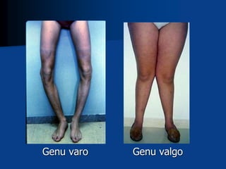 Genu varo Genu valgo
 