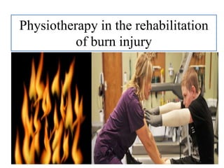 Physiotherapy in the rehabilitation
of burn injury
 