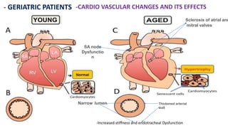 - GERIATRIC PATIENTS -CARDIO VASCULAR CHANGES AND ITS EFFECTS
Sclerosis of atrial and
mitral valves
SA node
Dysfunctio
n
Thickened arterial
wall
Narrow lumen
-Increased stiffness and endotracheal Dysfunction
 