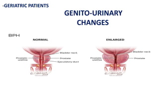 -GERIATRIC PATIENTS
GENITO-URINARY
CHANGES
 