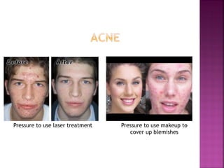 Pressure to use laser treatment Pressure to use makeup to
cover up blemishes
 
