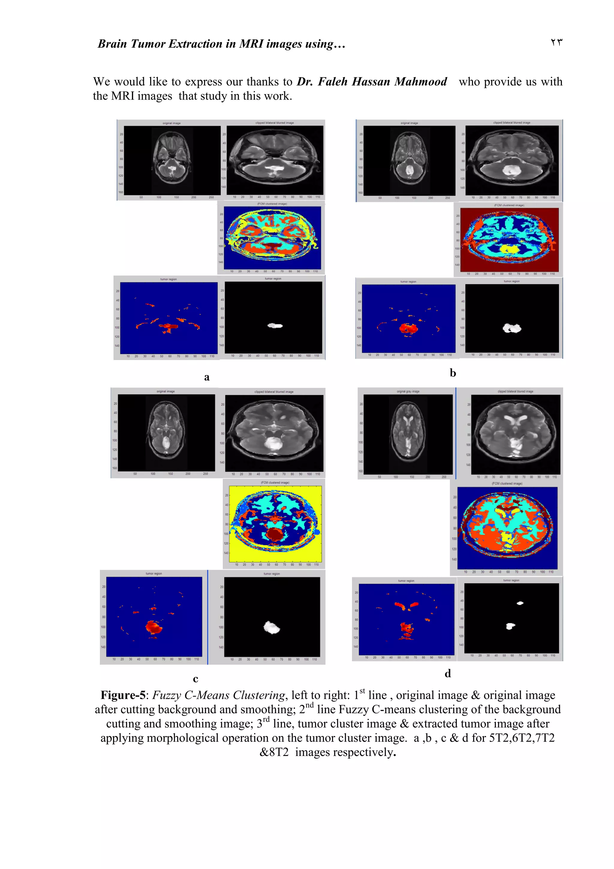 22Brain Tumor Extraction in MRI images using…
a b
c d
We would like to express our thanks to Dr. Faleh Hassan Mahmood who provide us with
the MRI images that study in this work.
Figure-5: Fuzzy C-Means Clustering, left to right: 1st
line , original image & original image
after cutting background and smoothing; 2nd
line Fuzzy C-means clustering of the background
cutting and smoothing image; 3rd
line, tumor cluster image & extracted tumor image after
applying morphological operation on the tumor cluster image. a ,b , c & d for 5T2,6T2,7T2
&8T2 images respectively.
 