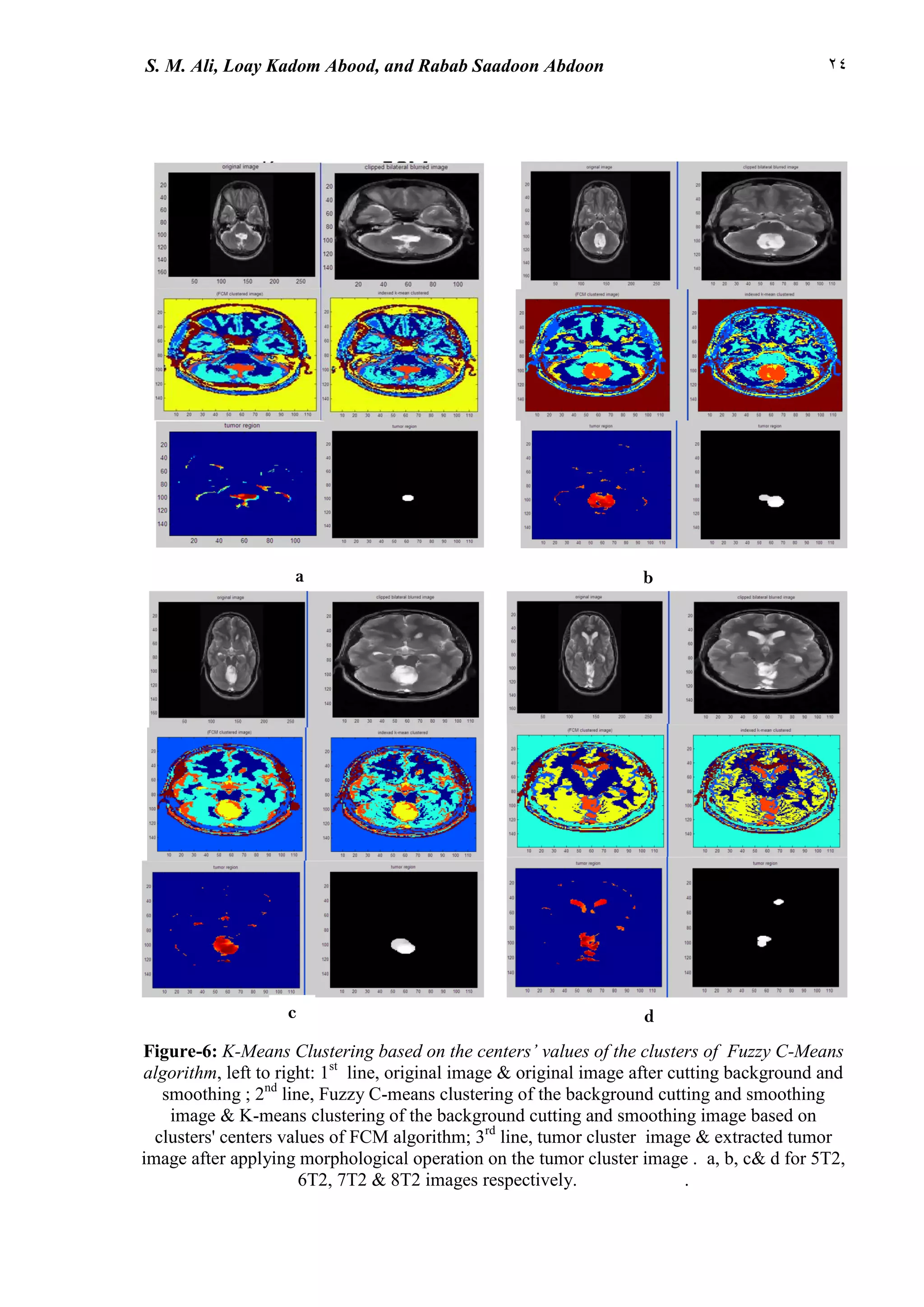 22S. M. Ali, Loay Kadom Abood, and Rabab Saadoon Abdoon
a b
d
Figure-6: K-Means Clustering based on the centers’ values of the clusters of Fuzzy C-Means
algorithm, left to right: 1st
line, original image & original image after cutting background and
smoothing ; 2nd
line, Fuzzy C-means clustering of the background cutting and smoothing
image & K-means clustering of the background cutting and smoothing image based on
clusters' centers values of FCM algorithm; 3rd
line, tumor cluster image & extracted tumor
image after applying morphological operation on the tumor cluster image . a, b, c& d for 5T2,
6T2, 7T2 & 8T2 images respectively. .
c
 