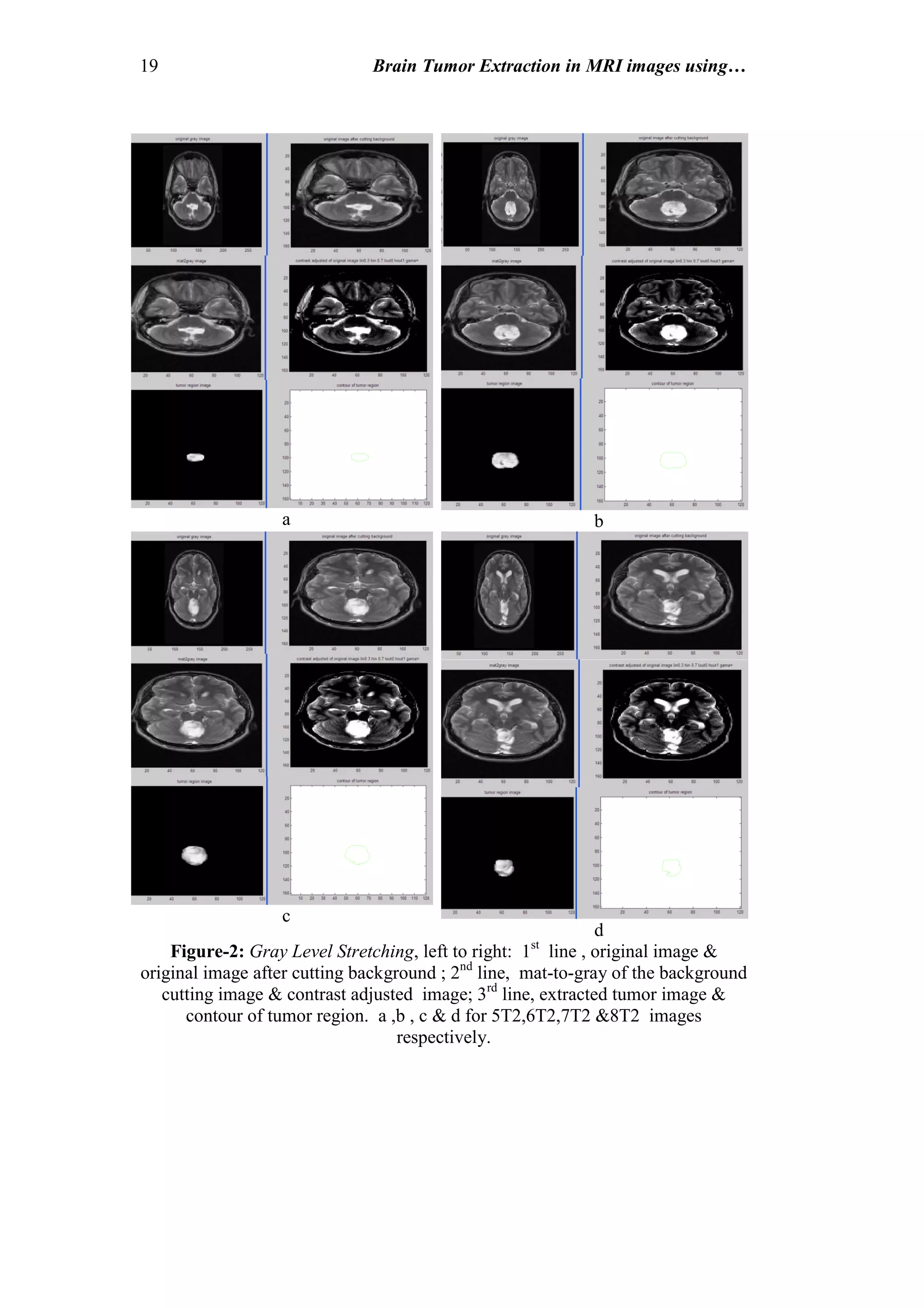 19 Brain Tumor Extraction in MRI images using…
a b
c
d
Figure-2: Gray Level Stretching, left to right: 1st
line , original image &
original image after cutting background ; 2nd
line, mat-to-gray of the background
cutting image & contrast adjusted image; 3rd
line, extracted tumor image &
contour of tumor region. a ,b , c & d for 5T2,6T2,7T2 &8T2 images
respectively.
 