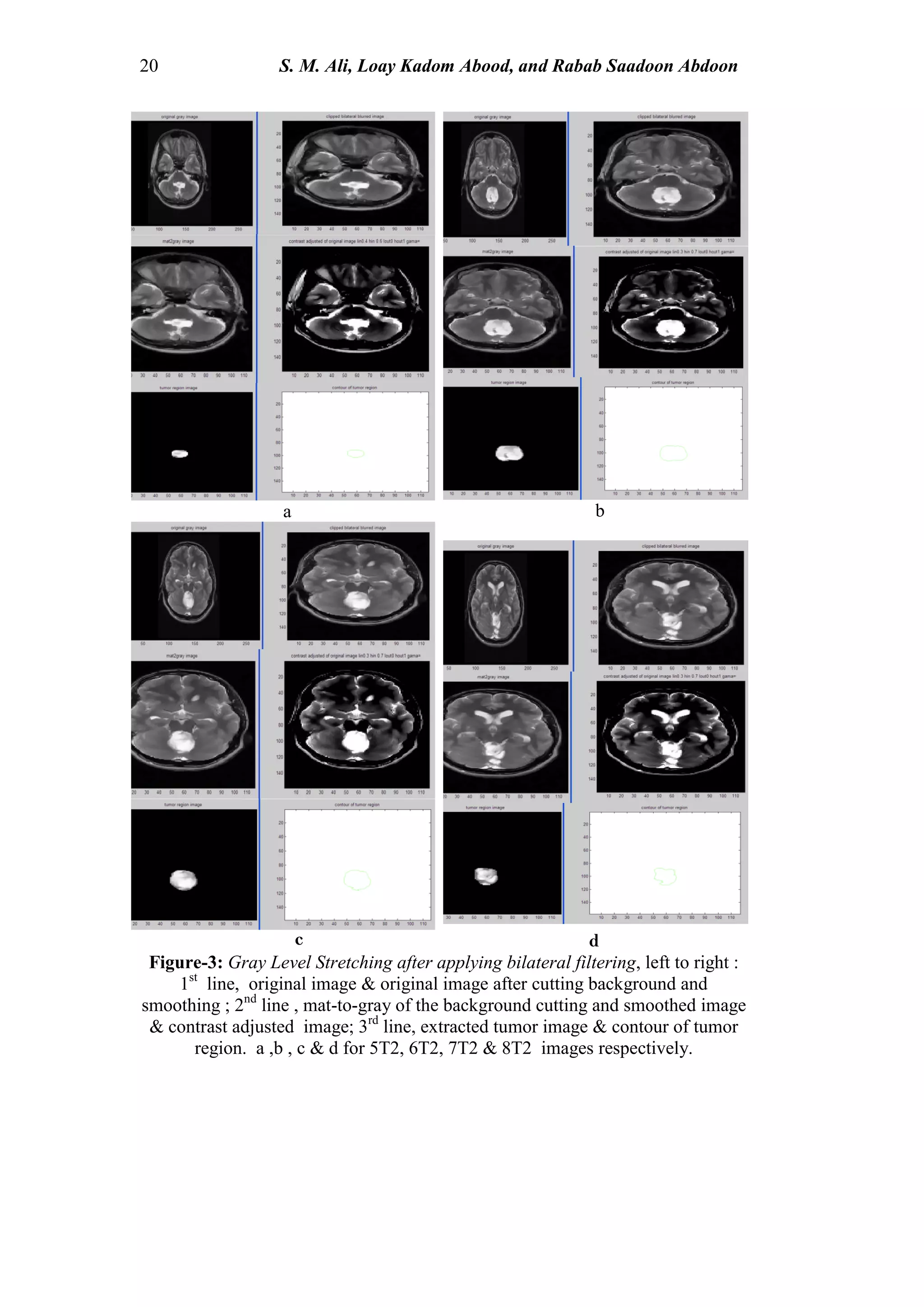 20 S. M. Ali, Loay Kadom Abood, and Rabab Saadoon Abdoon
c d
a b
Figure-3: Gray Level Stretching after applying bilateral filtering, left to right :
1st
line, original image & original image after cutting background and
smoothing ; 2nd
line , mat-to-gray of the background cutting and smoothed image
& contrast adjusted image; 3rd
line, extracted tumor image & contour of tumor
region. a ,b , c & d for 5T2, 6T2, 7T2 & 8T2 images respectively.
 