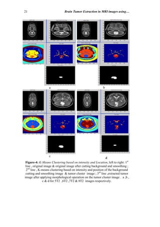 21 Brain Tumor Extraction in MRI images using…
d
a b
c
Figure-4: K-Means Clustering based on intensity and Location, left to right: 1st
line , original image & original image after cutting background and smoothing ;
2nd
line , K-means clustering based on intensity and position of the background
cutting and smoothing image & tumor cluster image ; 3rd
line ,extracted tumor
image after applying morphological operation on the tumor cluster image . a ,b ,
c & d for 5T2 ,6T2 ,7T2 & 8T2 images respectively.
 