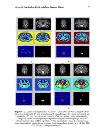22S. M. Ali, Loay Kadom Abood, and Rabab Saadoon Abdoon
a b
d
Figure-6: K-Means Clustering based on the centers’ values of the clusters of Fuzzy C-Means
algorithm, left to right: 1st
line, original image & original image after cutting background and
smoothing ; 2nd
line, Fuzzy C-means clustering of the background cutting and smoothing
image & K-means clustering of the background cutting and smoothing image based on
clusters' centers values of FCM algorithm; 3rd
line, tumor cluster image & extracted tumor
image after applying morphological operation on the tumor cluster image . a, b, c& d for 5T2,
6T2, 7T2 & 8T2 images respectively. .
c
 