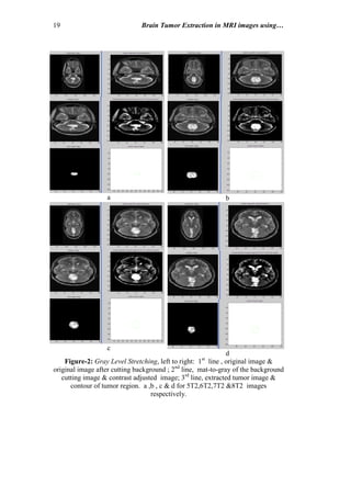 19 Brain Tumor Extraction in MRI images using…
a b
c
d
Figure-2: Gray Level Stretching, left to right: 1st
line , original image &
original image after cutting background ; 2nd
line, mat-to-gray of the background
cutting image & contrast adjusted image; 3rd
line, extracted tumor image &
contour of tumor region. a ,b , c & d for 5T2,6T2,7T2 &8T2 images
respectively.
 