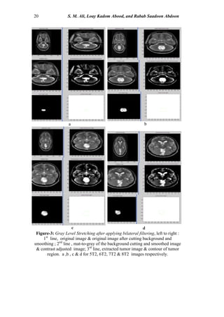 20 S. M. Ali, Loay Kadom Abood, and Rabab Saadoon Abdoon
c d
a b
Figure-3: Gray Level Stretching after applying bilateral filtering, left to right :
1st
line, original image & original image after cutting background and
smoothing ; 2nd
line , mat-to-gray of the background cutting and smoothed image
& contrast adjusted image; 3rd
line, extracted tumor image & contour of tumor
region. a ,b , c & d for 5T2, 6T2, 7T2 & 8T2 images respectively.
 